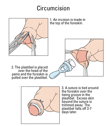 Plastibell circumcision technique