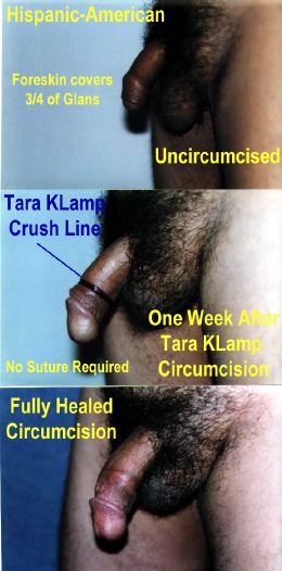 TaraKLamp circumcision, before and after (30,340 bytes)
