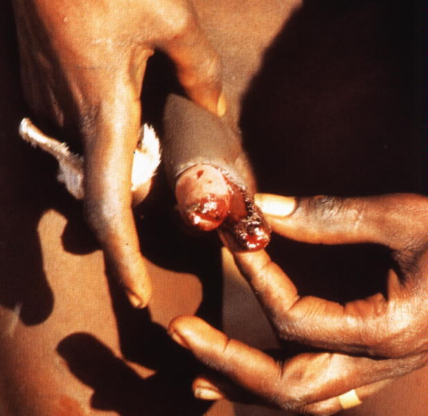 Circumcised Ethiopian Women Videos Porn 48